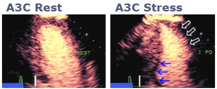 An Example of an Inferior Wall Perfusion Defect, JACC: CARDIOVASCULAR IMAGING, VOL 3, NO 2., 2010